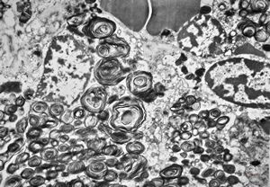 M, 6m. | Niemann-Pick disease - spleen M, 6m. | Niemann-Pick disease - spleen